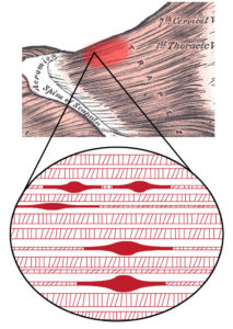 Acupuncture trigger point